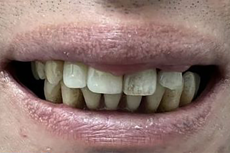 sugarland before and after dental treatment
