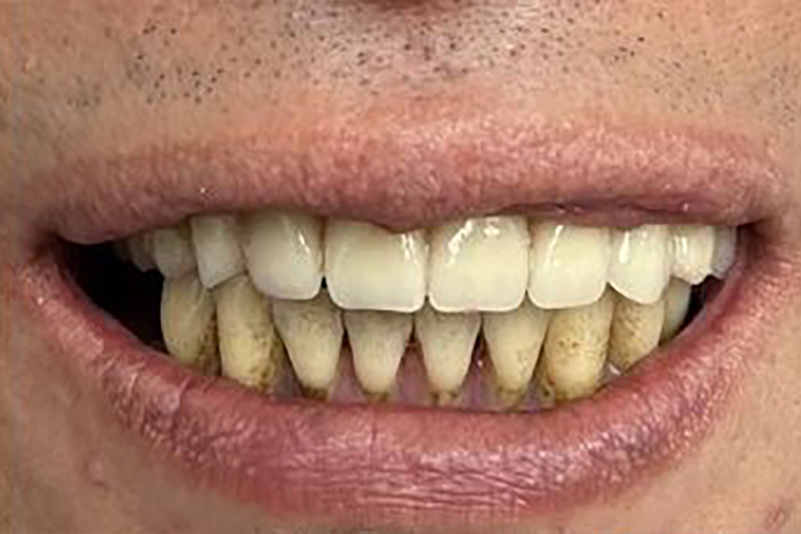 sugarland before and after dental treatment