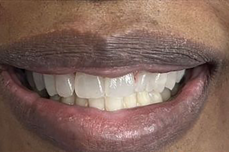 sugarland before and after dental treatment